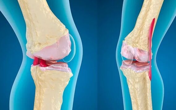 Gonarthrosis ของข้อเข่าระดับ 3