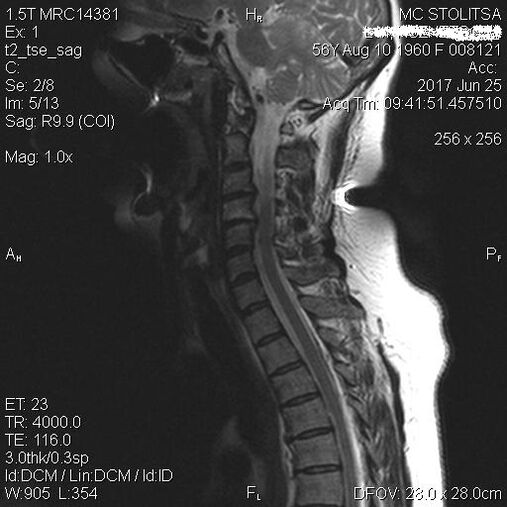 osteochondrosis และ spondylosis ของกระดูกสันหลังส่วนคอ