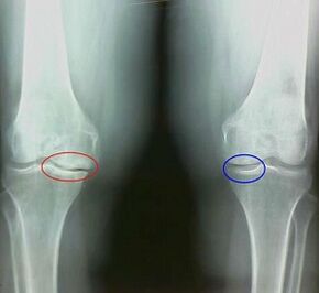 ผลของการรักษาโรคข้ออักเสบและการเยียวยาพื้นบ้าน arthrosis
