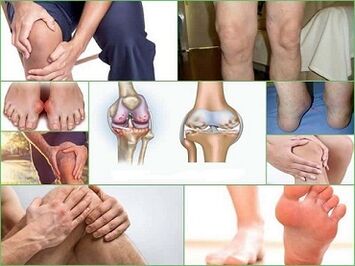วิธีป้องกันการพัฒนาของโรคข้ออักเสบและโรคข้อบกพร่อง