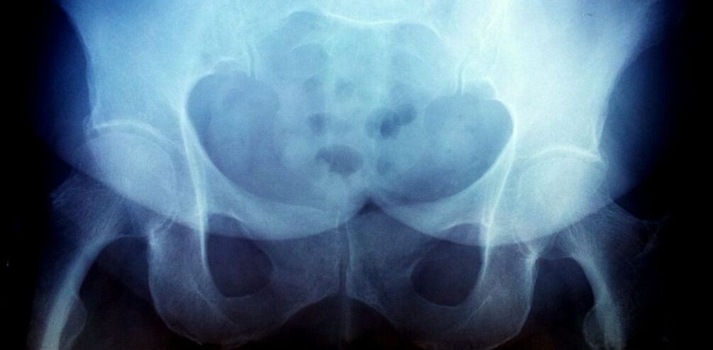 x -ray picture with arthrosis ของระดับที่ 2